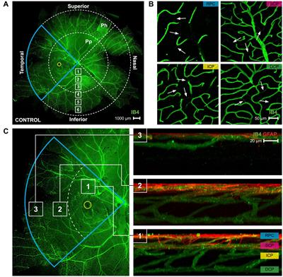 Age exacerbates the effect of myopia on retinal capillaries and string vessels